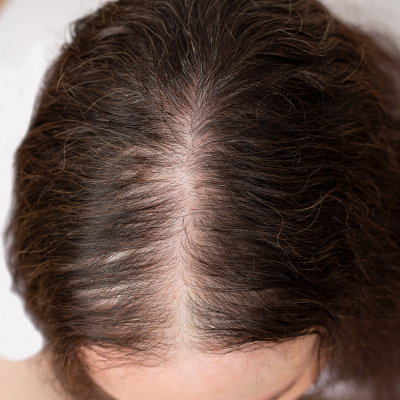 FEMALE HAIR LOSS SOLUTIONS THE HAIR LOSS CLINIC UK