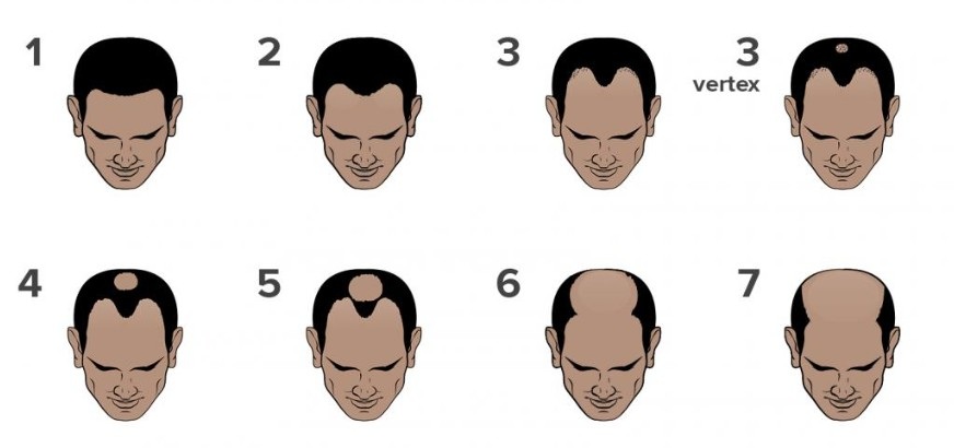 The best online hair loss consultations in the UK