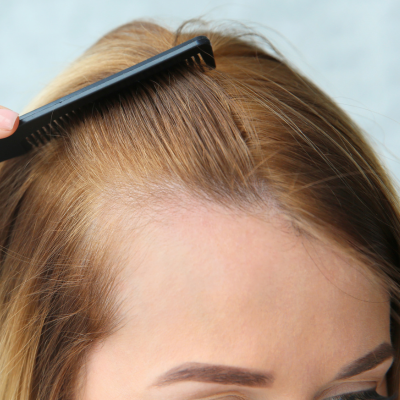 THINNING HAIR TREATMENTS ONLINE AT THE HAIR LOSS CLIIC UK