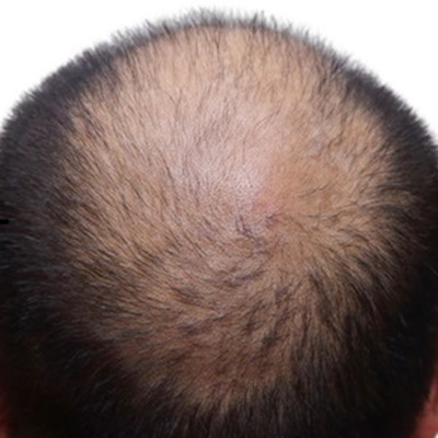 online hair loss serums at The Hair Loss Clinic Uk