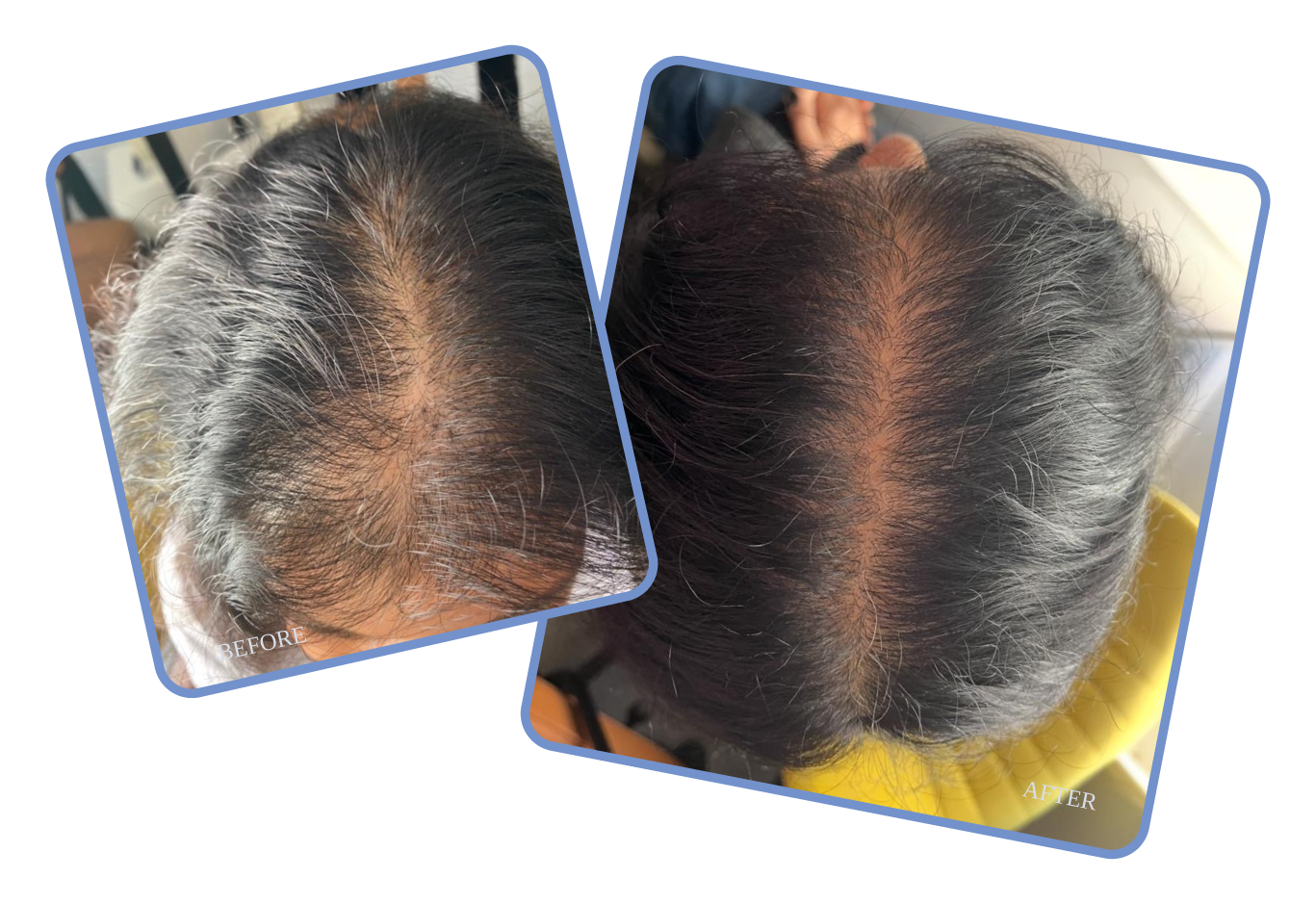 hair loss transformations at The Hair Loss Clinic UK