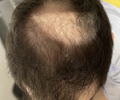ONLINE PHARMACEUTICAL HAIR LOSS SERUMS UK
